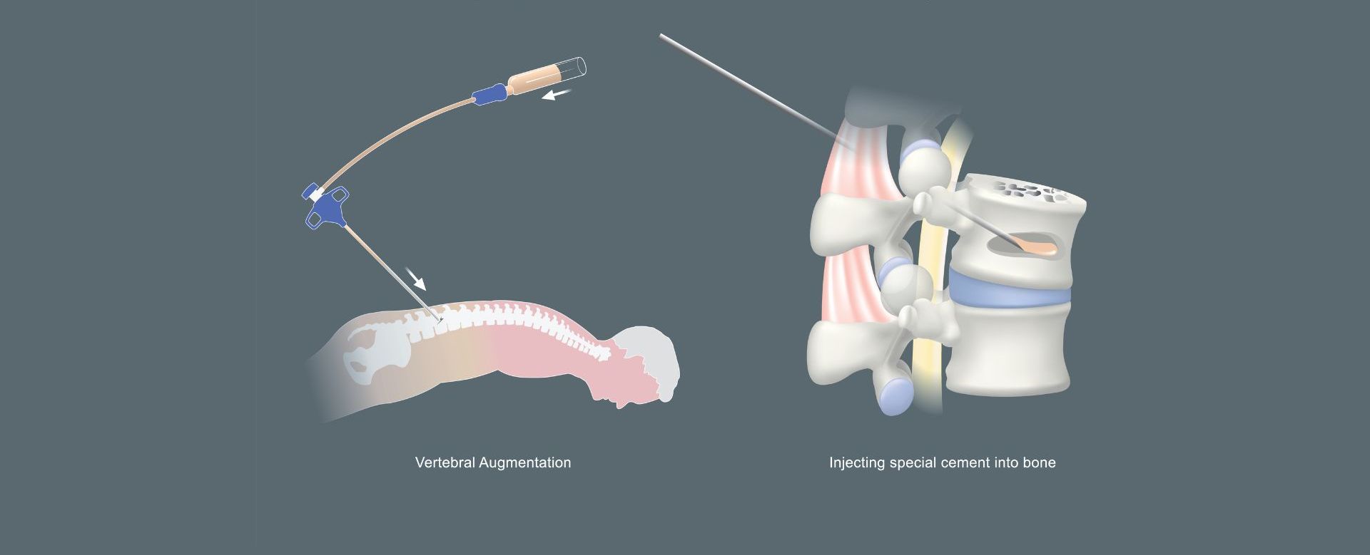 spondyloplastiki kyfoplastiki kentriki